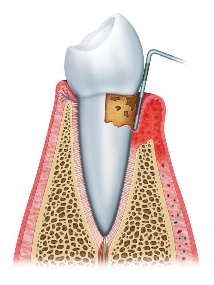 ⚙️ Root Canal Therapy