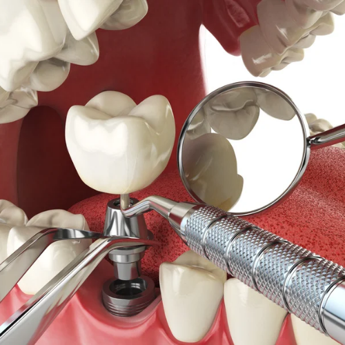 Dental Implants 🧩