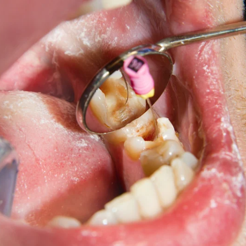 Root Canal Treatment 🪥