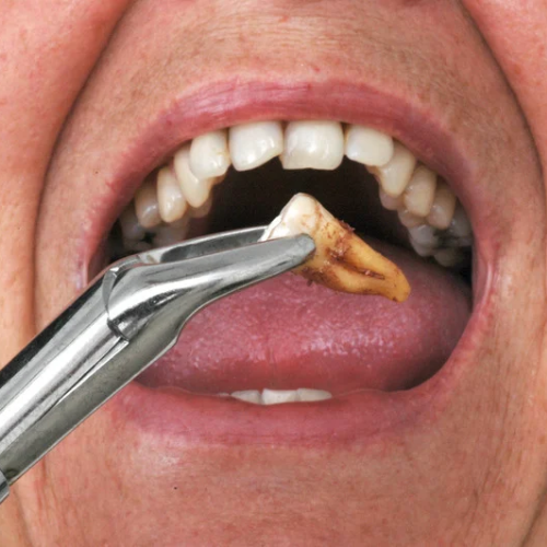 Tooth Extractions 🦷