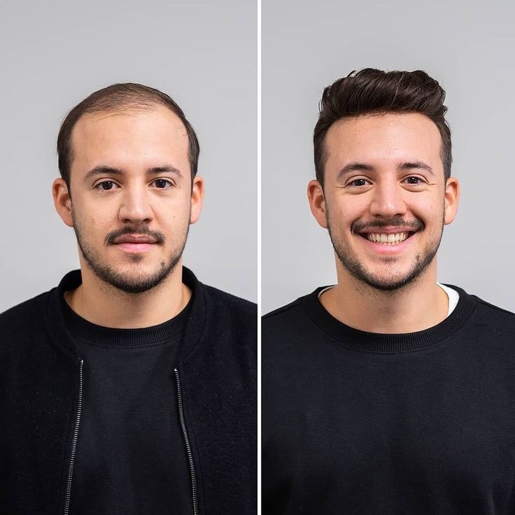 Hair Replacement Solutions
