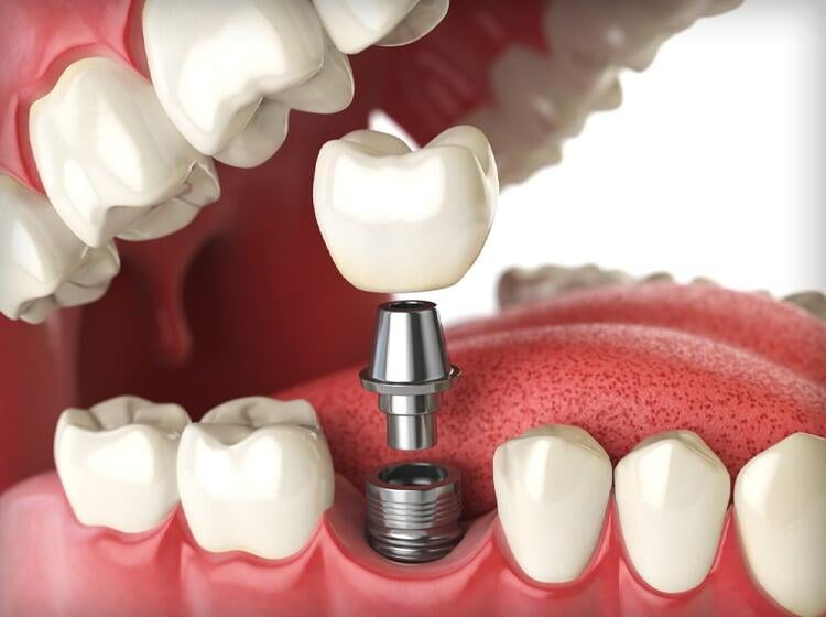 🦷 Dental Implants