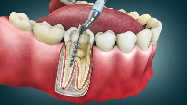 🦷 Root Canal Treatment