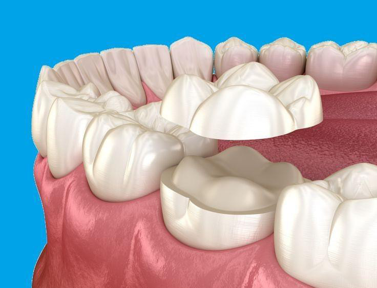 👑 Dental Crowns